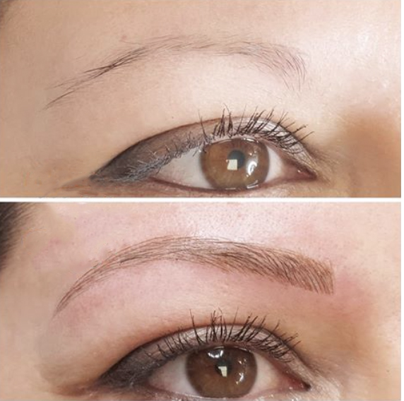 beforeafterhairlinemicrobladinglosangeles